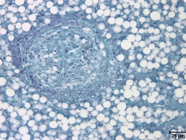 Mycobacterial Lesion in Fish Liver (Acid-Fast Stain)